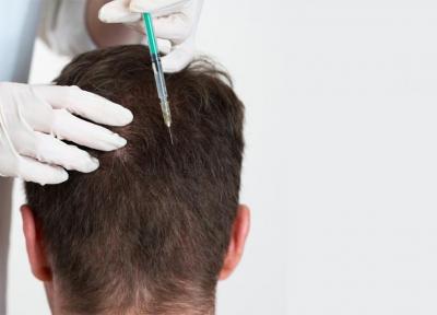 روشی برای درمان ریزش مو، مزوتراپی کم پشتی مو را درمان می نماید؟